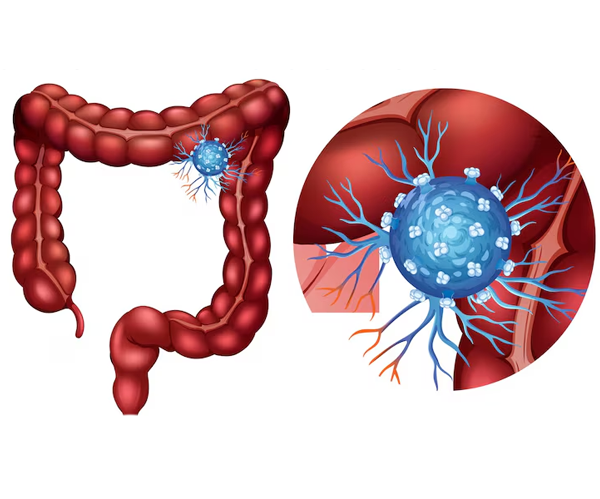 Gastrointestinal Cancer