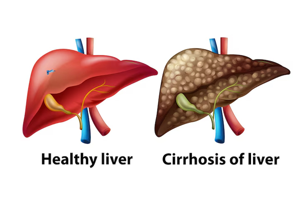 Liver Cirrhosis
