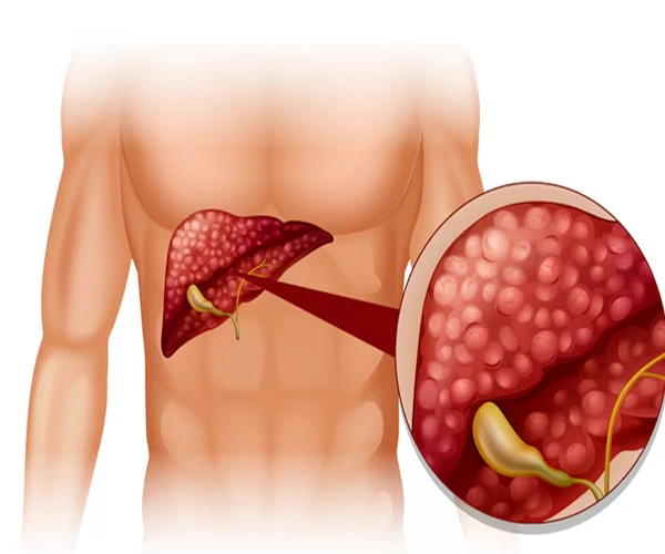 Liver Cirrhosis