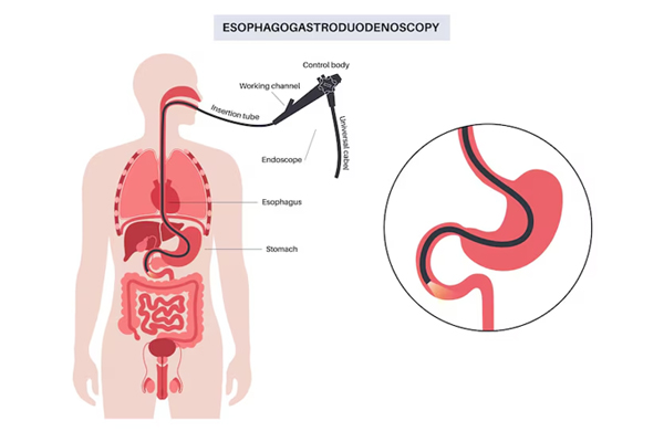 Esophagus Procedures