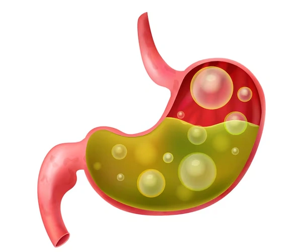 Ascites