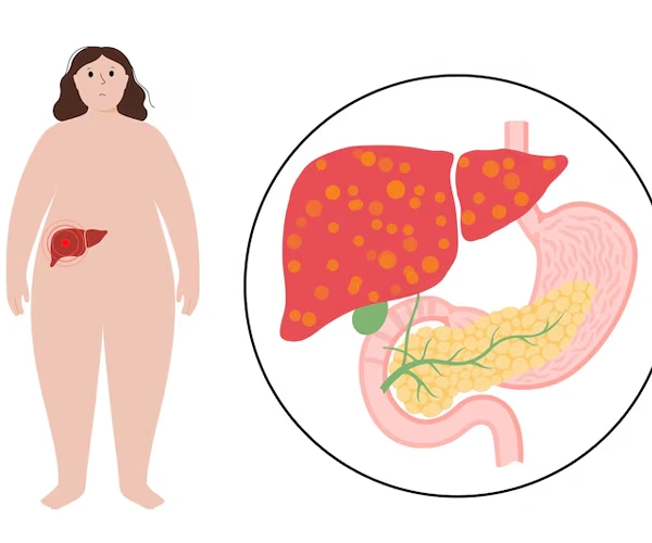 Liver Diseases