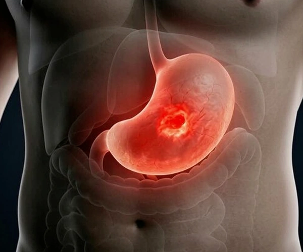 Cystic Neoplasm of Pancreas