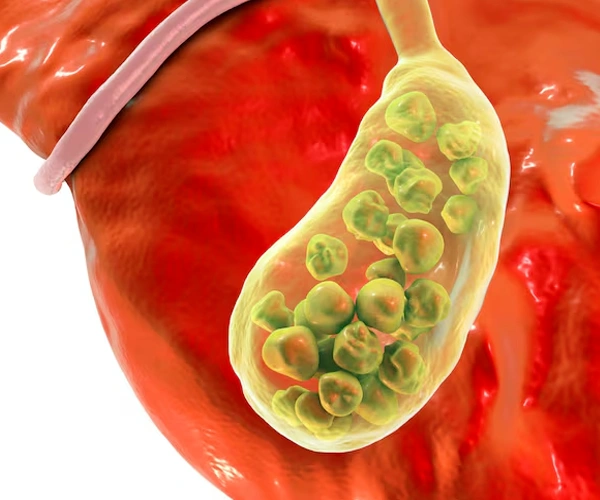 Common Bile Duct Stone