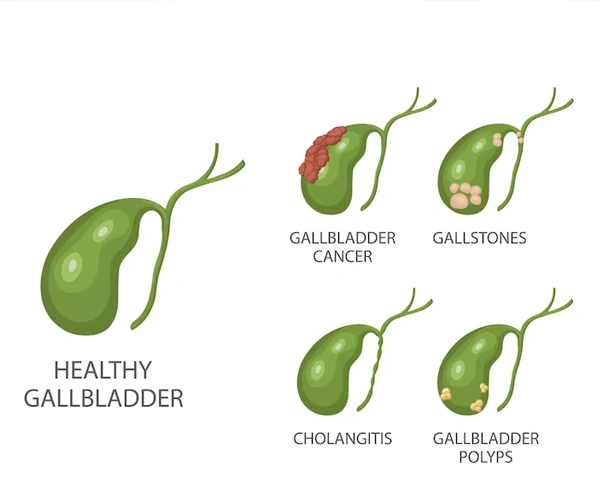 Gall Bladder Diseases