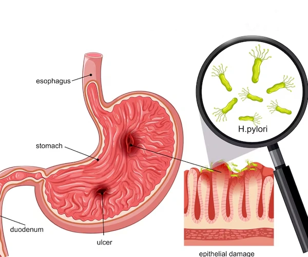 H Pylori Infection