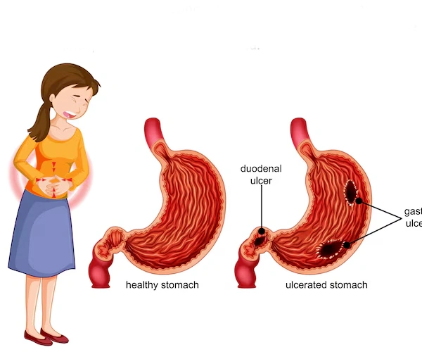 Stomach Diseases