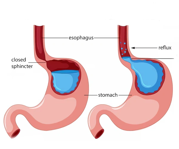 Achalasia Cardia
