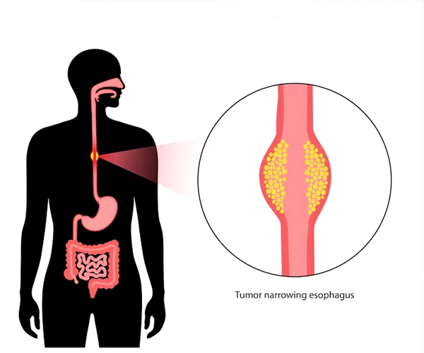 Esophageal Cancer