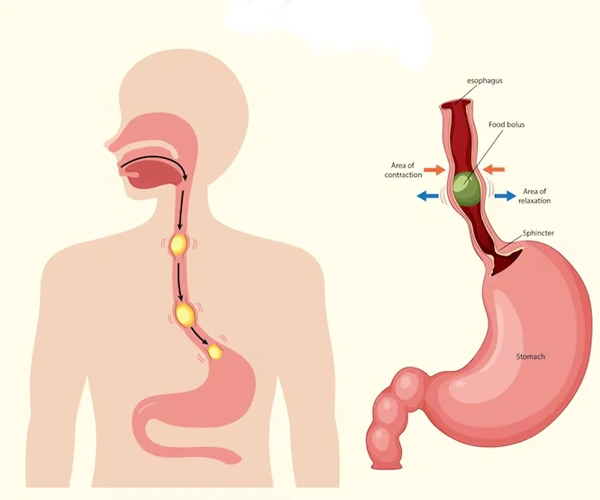 Eosinophilic Esophagitis