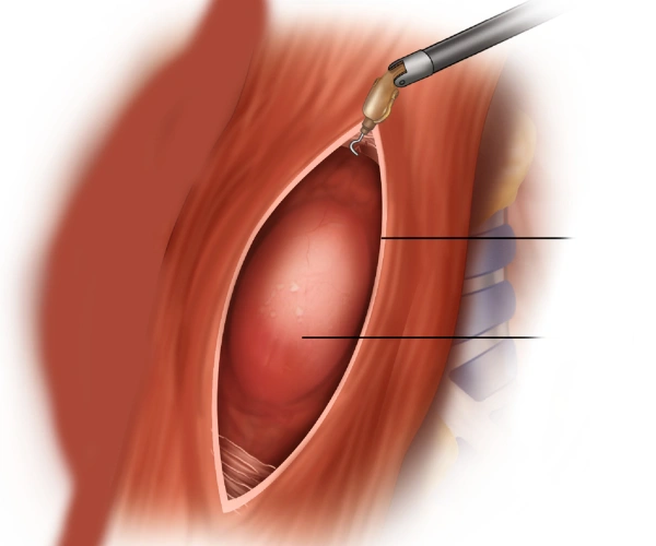 Esophageal Leiomyoma