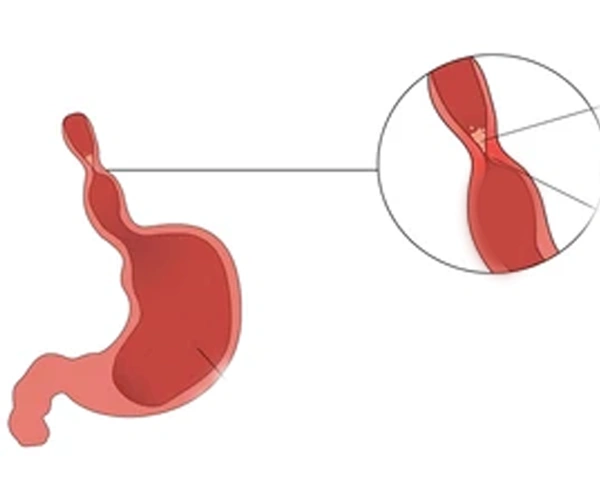 Esophageal Stricture and Web