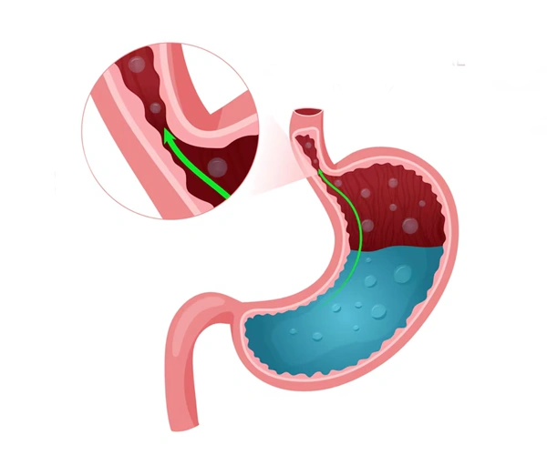 Gastroesophageal Reflux