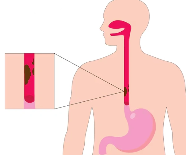 Esophagus Diseases