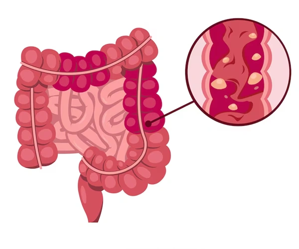 Colonic Polyps and Cancer