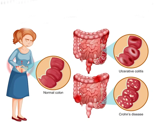 Inflammatory Bowel Disease
