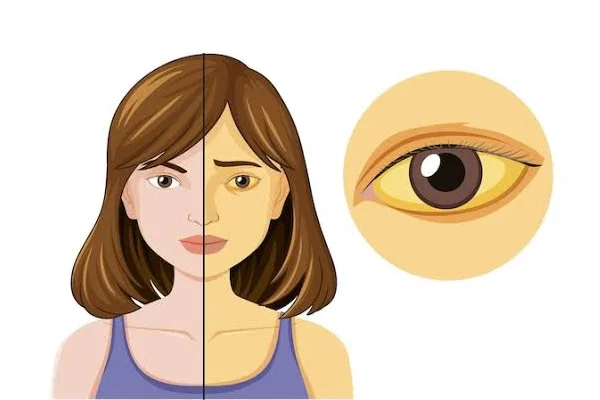 Jaundice
